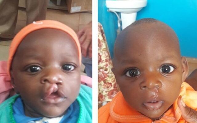 Fentes labio-palatines : une campagne chirurgicale d’envergure pour redonner le sourire aux enfants gabonais